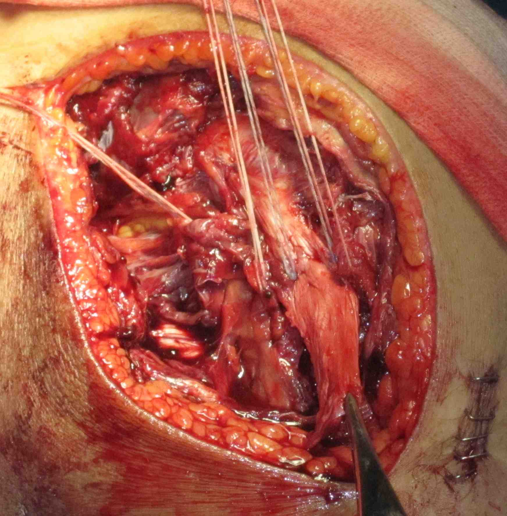 MCL Tibial Avulsion